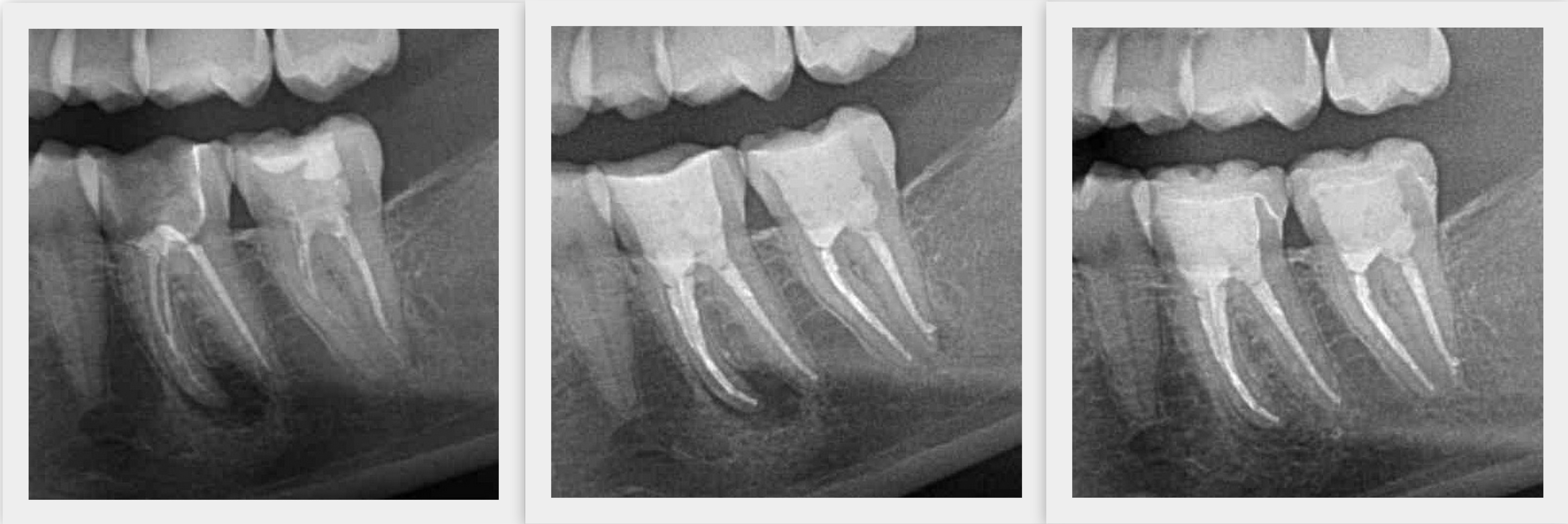 Grau wird wurzelbehandelter zahn Schwarzer Zahn