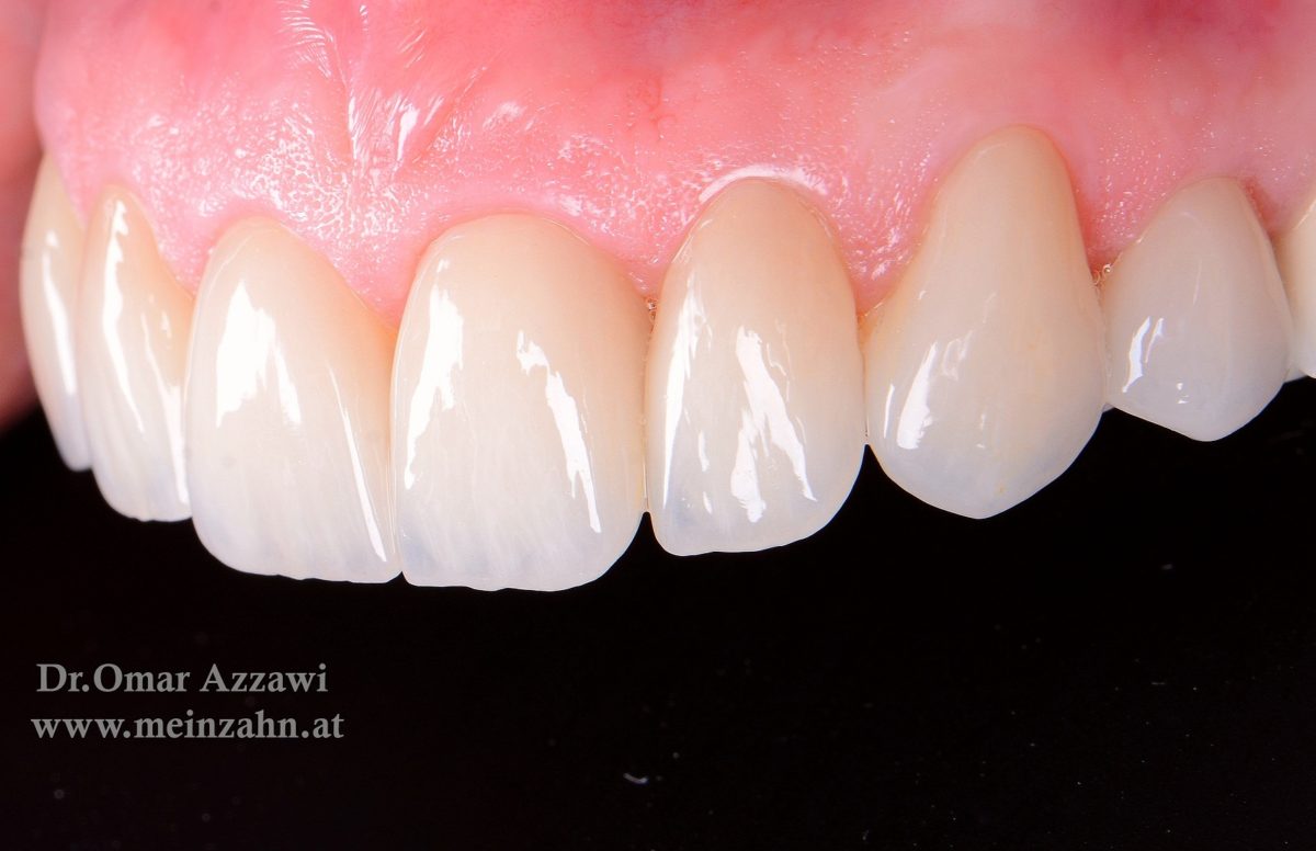 Veneers Wien ästhetische Frontzahnkorrekturen Zahnarzt Dr. Zsolt